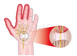 Carpal-Tunnel-Syndrome_86604217-watermark