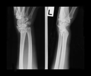 wrist-fracture_161889089-new
