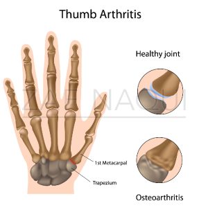 base-of-thumb-arthritisCMCJ-OA-Graphic_98308460